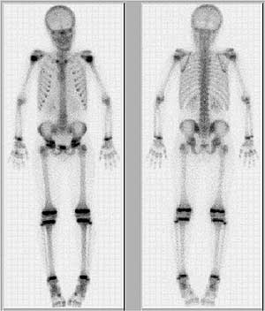 Bone scan, depicting bone metabolism in young patient