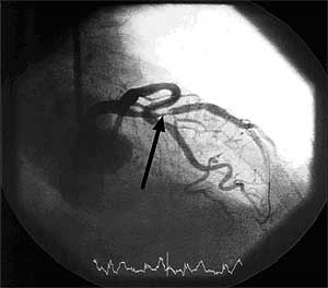 Coronarography of patient with LAD Stenosis