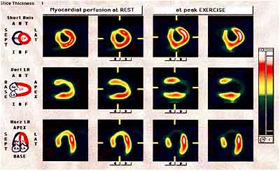 Tomographic image of myocardial perfusion defect at exercise 