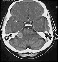 CT image with beam hardening artefacts 